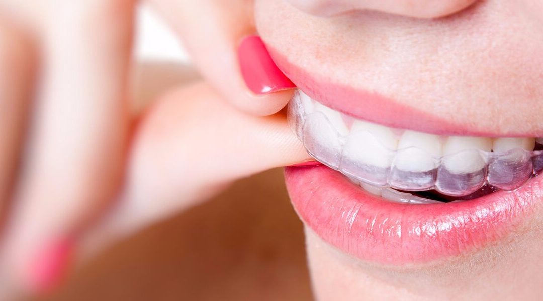 Getting the most out of Invisalign