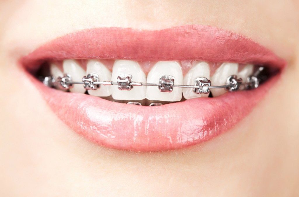 Looking after your fixed braces